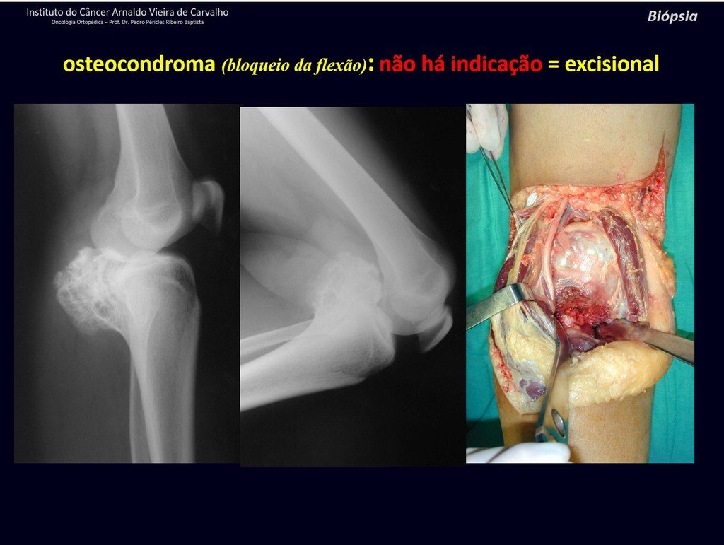 Figura 28: Osteocondroma séssil da tíbia. Não há indicação de biópsia. Indicação de ressecção por bloqueio da flexão do joelho.