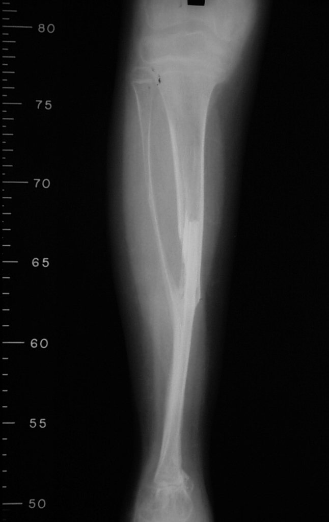 Figura 44: Radiografia após um ano e sete meses, fíbula tibializada e fise viável, solução biológica que permite a equalização dos membros com o crescimento.