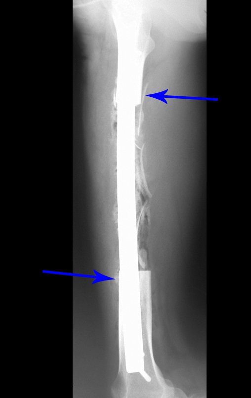 Figura 38: Radiografia, perfil, reconstrução com enxerto ósseo autólogo e osteossíntese com placa especial.