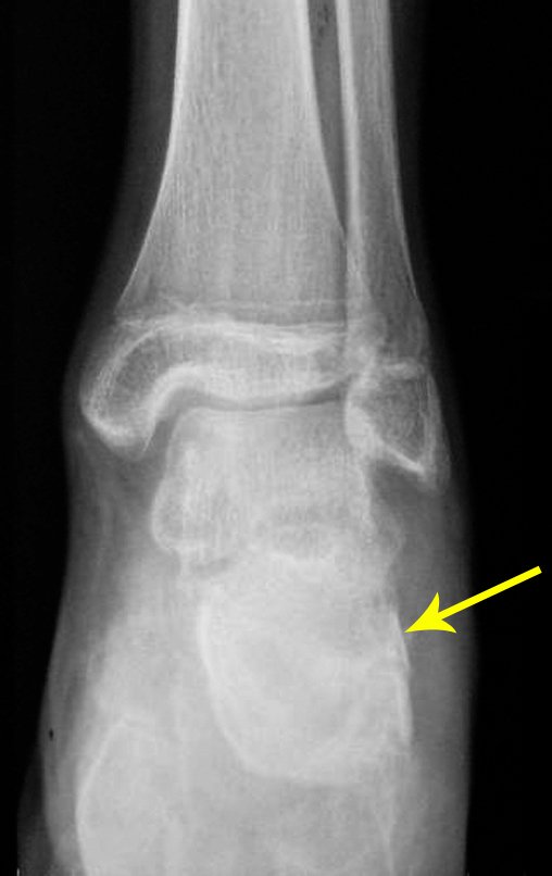 Figura 76: Radiografia de 01/03/2015, frente, enxerto consolidado, em integração.