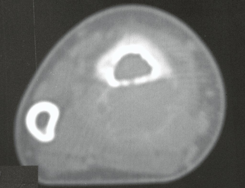 Figura 5: TC, densidade para tecidos moles, mostra a lesão circundada por fina cortical, sobrepondo-se à parede do osso proximal, porém sem invasão de tecidos moles.