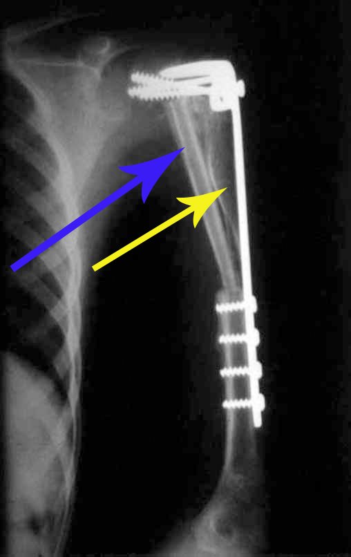 Figura 12: Radiografia do pós-operatório de um mês, reconstrução com enxerto autólogo de fíbula (seta azul), e de crista ilíaca (seta amarela).