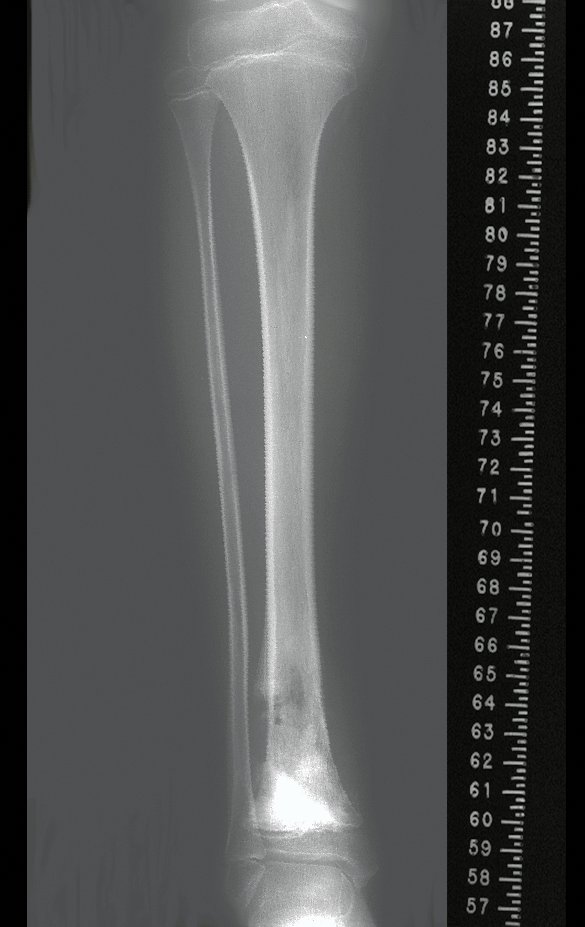 Figura 6: Escanograma da tibia, para planejamento cirúrgico.