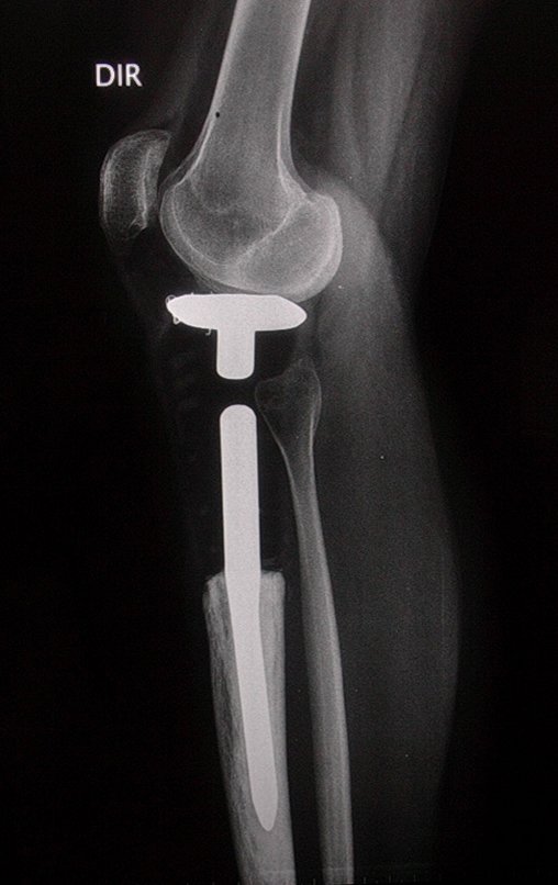 Figura 114: Radiografia em perfil, pós-operatório de dois anos.