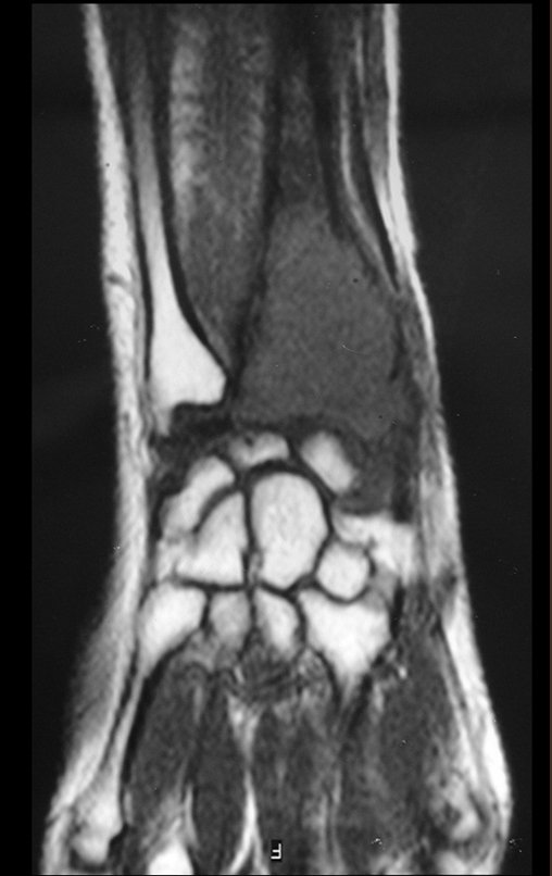 Figura 25: RM cor t1, lesão de rarefação óssea, com áreas de necrose, erosão, insuflação e fratura infracção da cortical, com deformidade e afundamento da superfície articular.