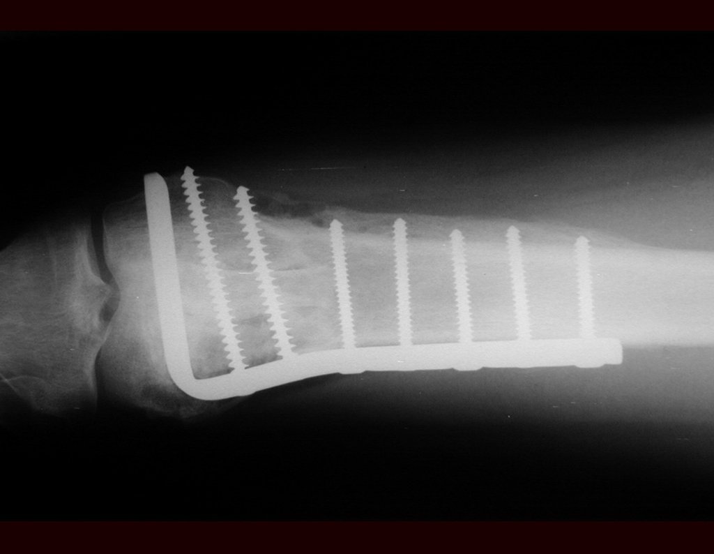 Figura 54: Radiografia de reconstrução de cisto ósseo com fratura. Observa-se o contorno do enxerto estruturado sendo integrado e a consolidação do enxerto fragmentado impactado.