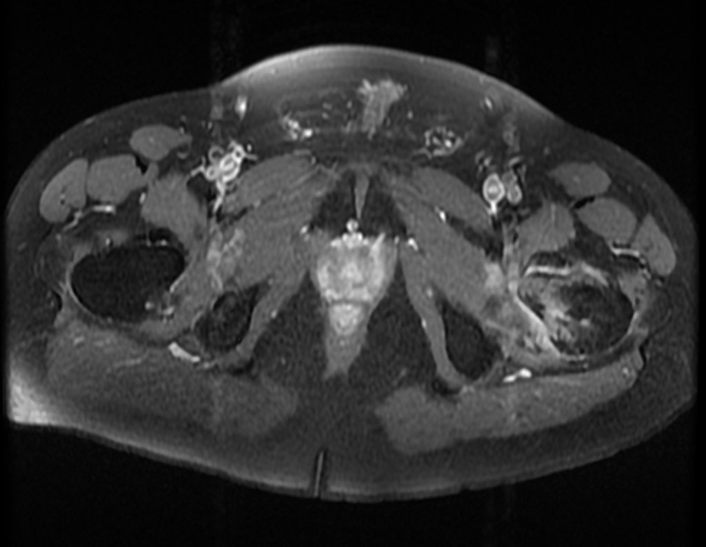 Figura 57: RM axial, aumento de captação na metáfise femoral.