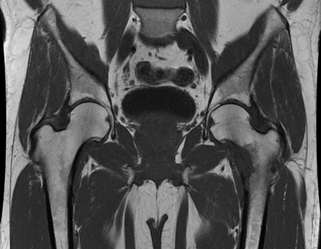 Figura 3: RM coronal T2, de 19/02/2015, com lesão de baixo sinal na face medial do colo femoral e região trocantérica.