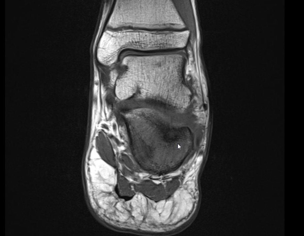 Figura 25: RM coronal T1, lesão com halo de esclerose, nicho central e edema articular.