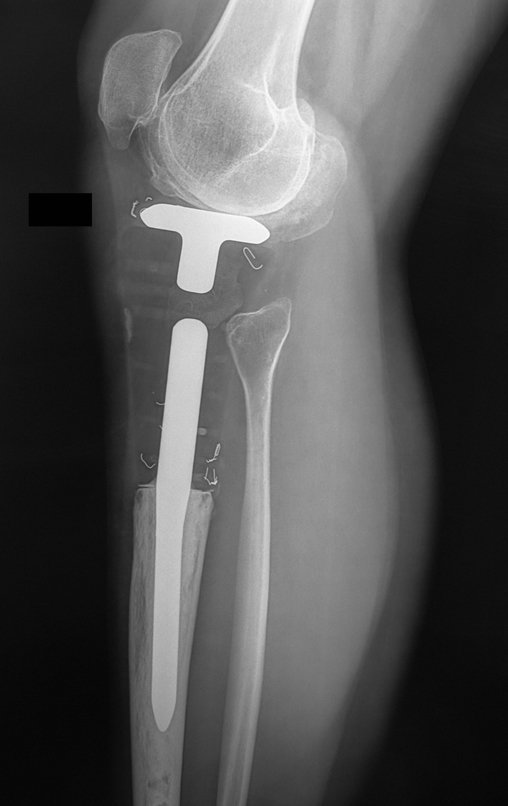 Figura 147: Radiografia de perfil, pós-operatório de seis anos e três meses.