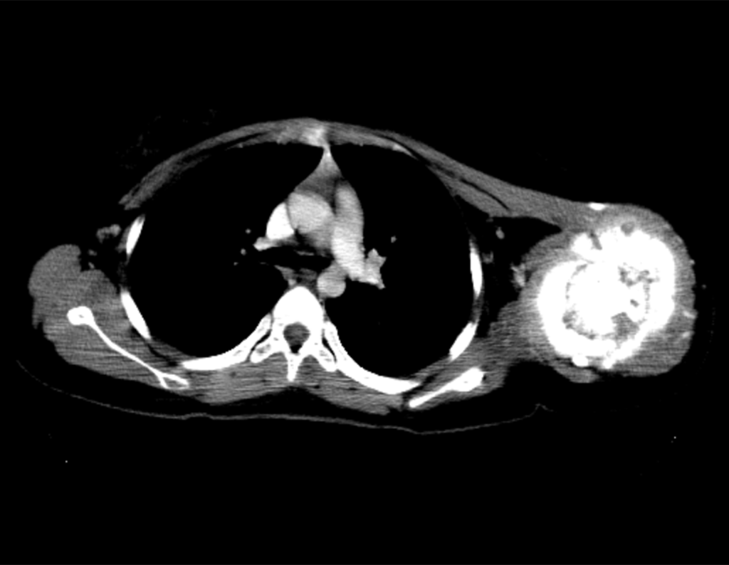 Figura 9: Grande massa tumoral estra cortical e comprometimento dos tecidos moles.