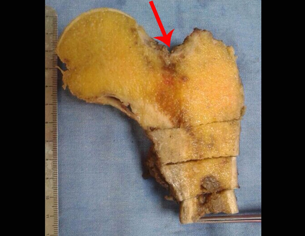 Figura 110: A seta em vermelho aponta a fratura na cortical superior do colo femoral.