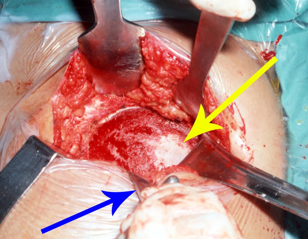 Figura 33: Cortical externa retirada e exposição para retirada do enxerto esponjoso. Seta amarela destacando a "ilha", que deve ser preservada. Seta azul assinala o afastador de Bennet, apoiado na incisura isquiática maior.