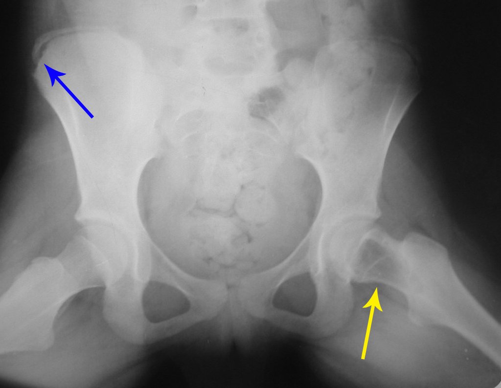 Figura 1: Radiografia da bacia, de 20/01/2001, com lesão de rarefação óssea no colo femoral esquerdo, seta amarela. Paciente iniciando a puberdade, com potencial de crescimento bem evidente analisando-se a linha de Risser, seta azul.