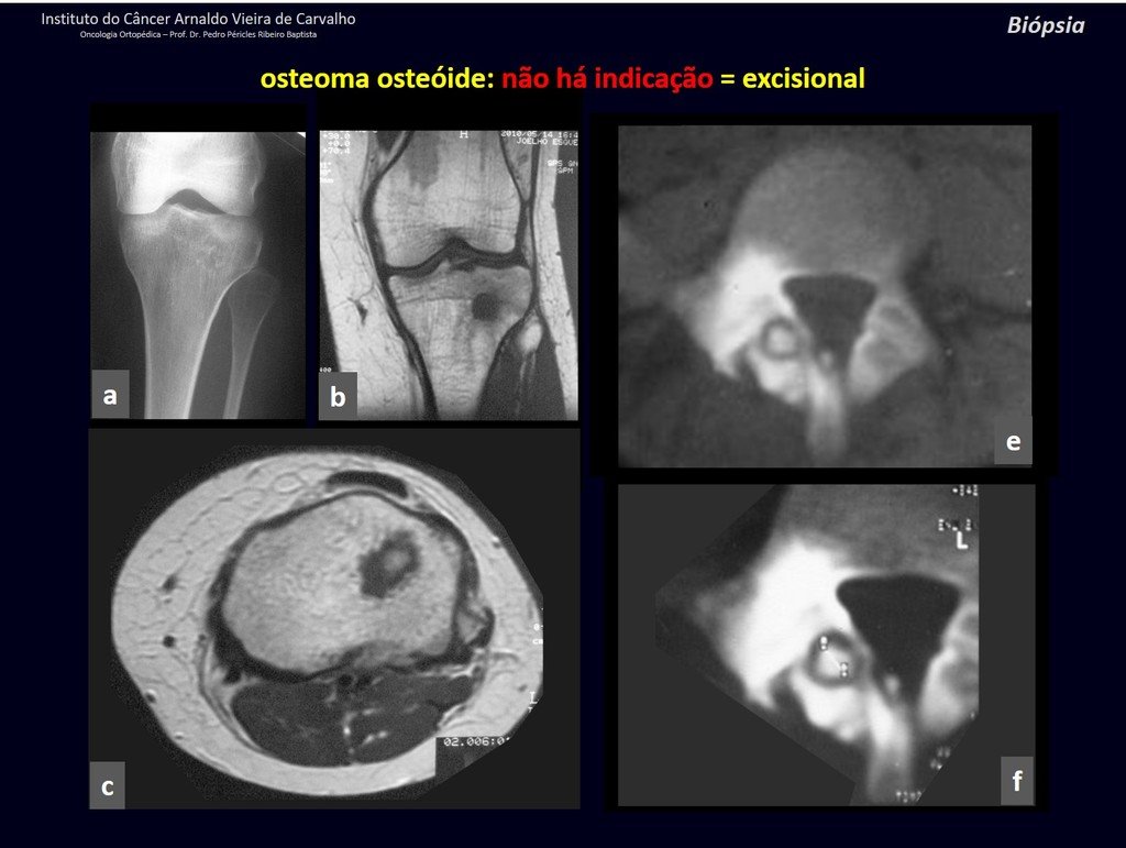 Figura 22: Imagens com osteoma osteóide da tíbia e do pedículo da coluna vertebral. Não há indicação de biópsia e sim de ressecção-biópsia.