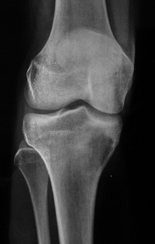 Figura 24. A: RX frente, após quimioterapia pré-operatória.