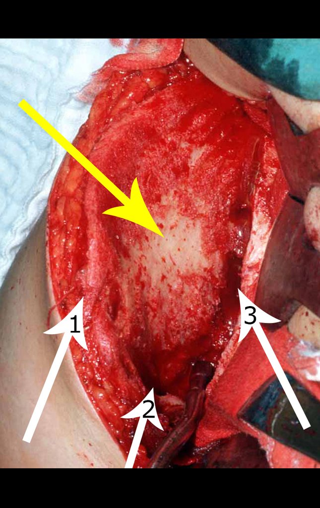 Figura 24: Enxerto retirado, sem lesar a "ilha" formada pela tábua interna e externa intactas, seta amarela. Setas brancas: 1- crista ilíaca, 2- teto acetabular e 3- coluna posterior, de onde foi retirado enxerto.