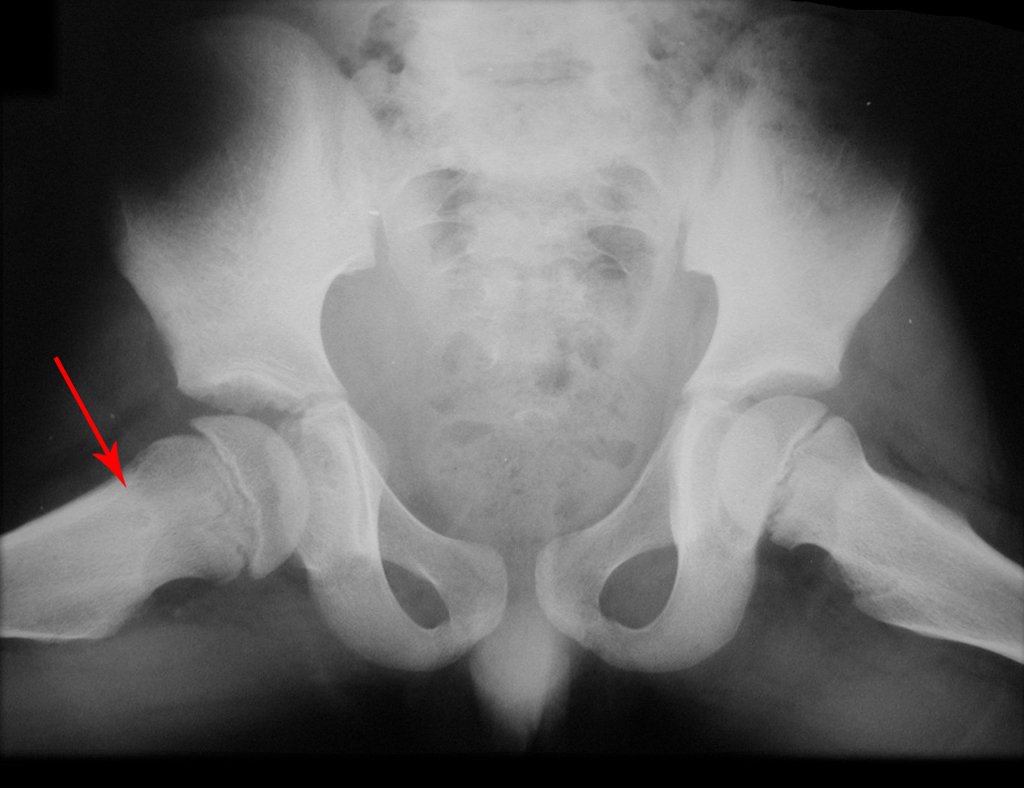 Figura 1: Radiografia da bacia, quadris em perfil, observa-se imagem nodular com cerca de 0,5 cm, no colo femoral direito.