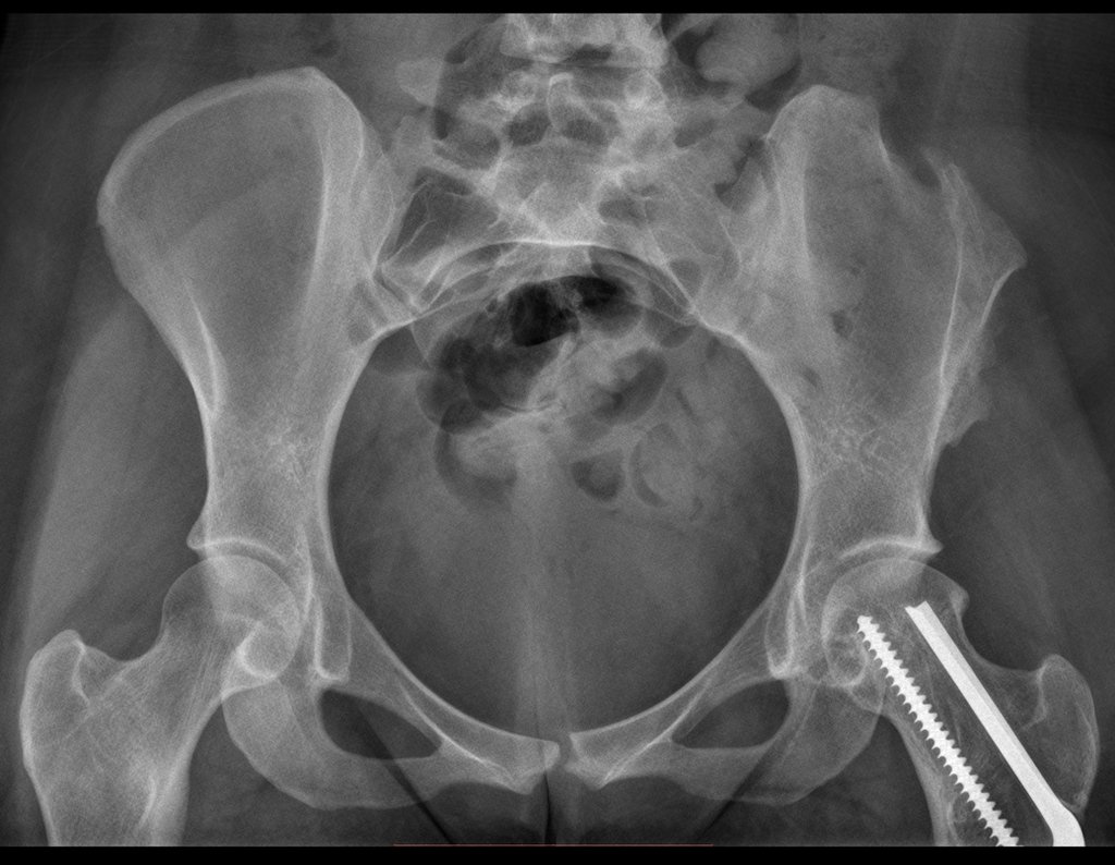 Figura 98: Radiografia da bacia de março de 2016, após doze anos da reconstrução. Detalhe do ilíaco esquerdo, área doadora do enxerto.