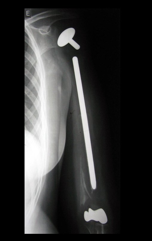 Figura 80: Radiografia de prótese de úmero total, com ressecção do deltoide e reconstrução com tela de marlex, suturada com pregueamento para permitir os movimentos, em 22/07/2015.