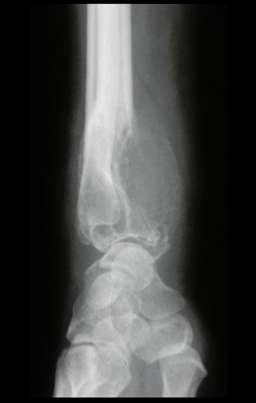 Figura 8: Radiografia perfil, após cinco meses, quando a paciente é avaliada em outro hospital.