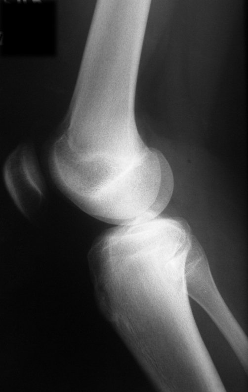 Figura B: Radiografia inicial em perfil, discreta rarefação posterior na metáfise proximal da tíbia direita.