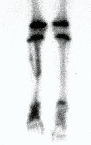 Figura 32: Cintilografia óssea da perna destacando a captação da fíbula e a ossificação do trajeto da transferência proximal, promovendo uma fusão proximal.