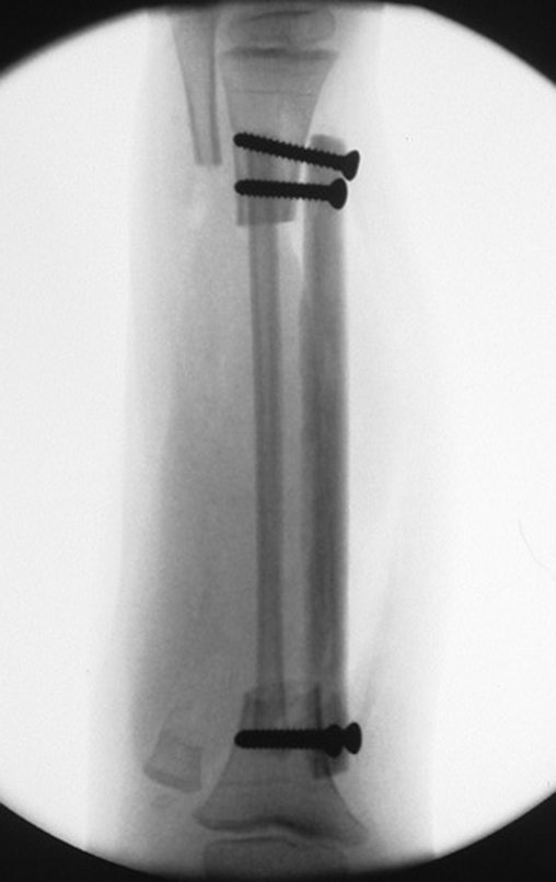 Figura 92: Radiografia do pós-operatório imediato, fíbula encavilhada nos segmentos da tíbia e enxerto homólogo fixado com parafusos.