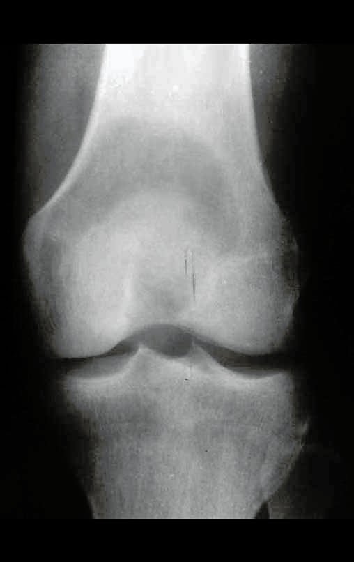 Figura 39: Radiografia do joelho, frente, com grande lesão de rarefação óssea, comprometendo toda a região epífise metafisária do fêmur direito.