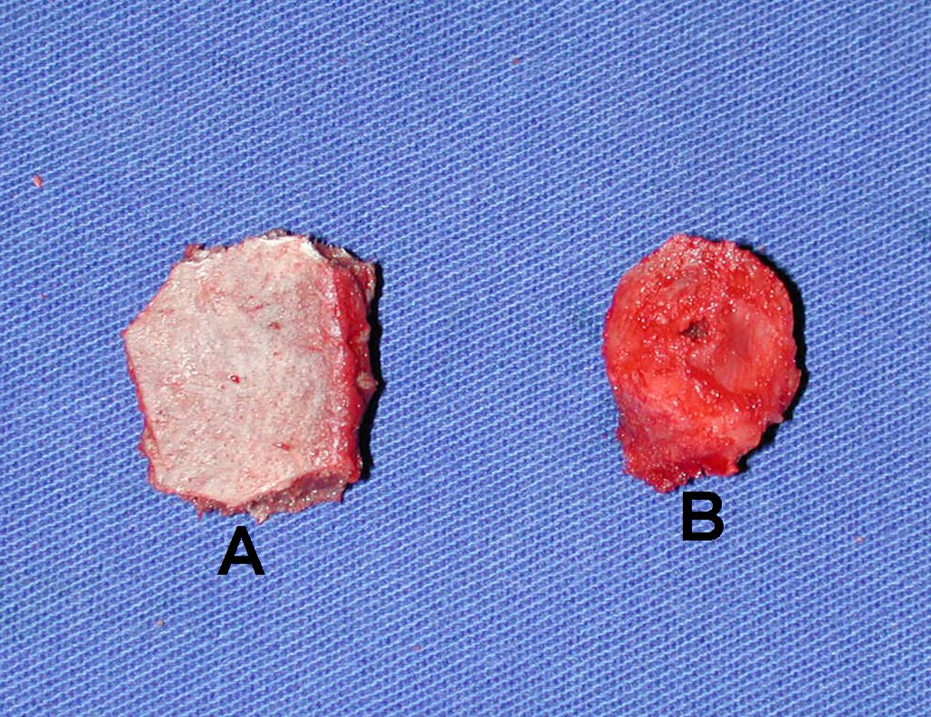 Figura 39: Enxerto modelado (A), conforme segmento ressecado (B).