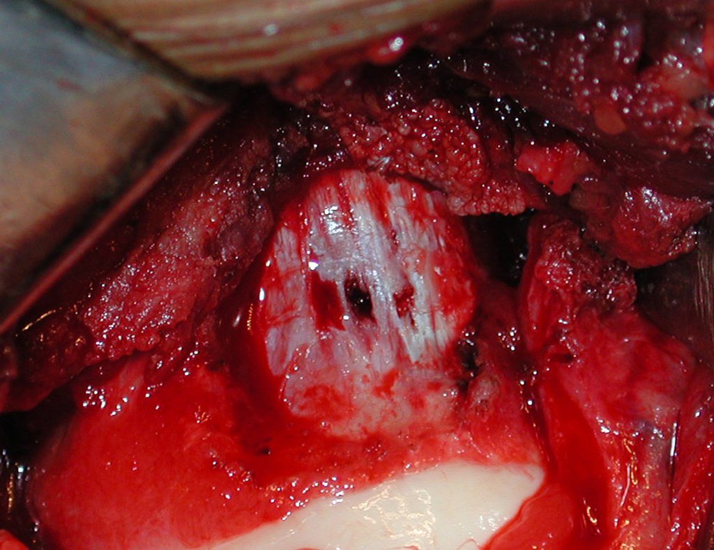 Figura 25: Descolamento do periósteo do colo femoral e visualização do orifício realizado com o fio de Kirschner.