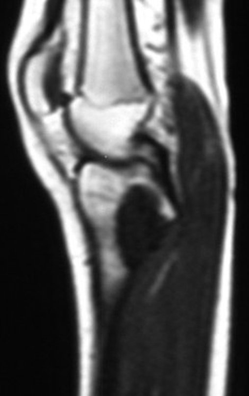 Figura 2. B: RM sag T1, lesão com baixo sinal na região meta epifisária proximal medial e posterior da tíbia direita.