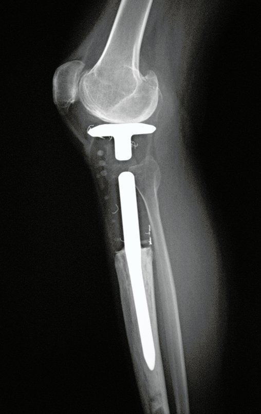 Figura 155: Radiografia, perfil. Pós-operatório de nove anos.