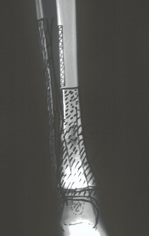 Figura 8: Planejamento cirurgico: Ressecção do 1/3 distal da tíbia, tibialização dos 2/3 distais da fíbula com a epífise e a placa de crescimento, abertura de janela na tibia para encaixe do terço médio e preservação da integridade da artéria nutrícia da fíbula.