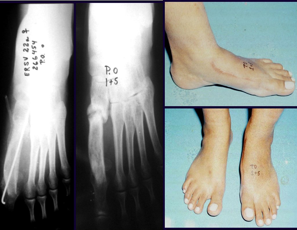 Figura 59: Radiografia da reconstrução; aspecto clínico pós operatório.