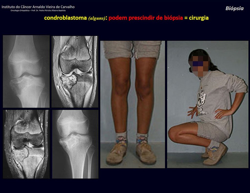 Figura 52: Lesão com matriz cartilaginosa, epifisária, em adolescente (esqueleto em crescimento), halo de esclerose, erosão da cartilagem articular e da cortical óssea, com focos de calcificação = CONDROBLASTOMA.