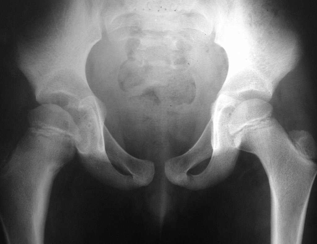 Figura 8: Radiografia de bacia frente, apresentando o colo femoral alargado à direita, esclerose na região do calca e áreas de rarefação medial.