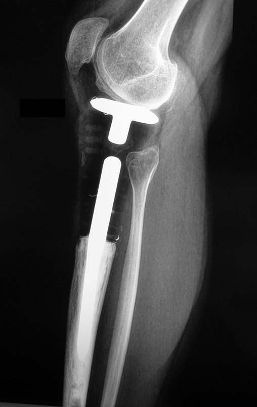 Figura 122: Radiografia, perfil, após três anos.