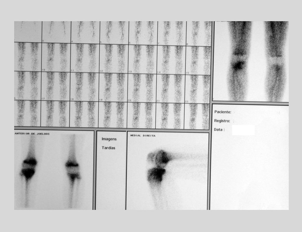 Figura 12: Cintilografia óssea, fase de fluxo, hipercaptação na metáfise proximal da tíbia direita.