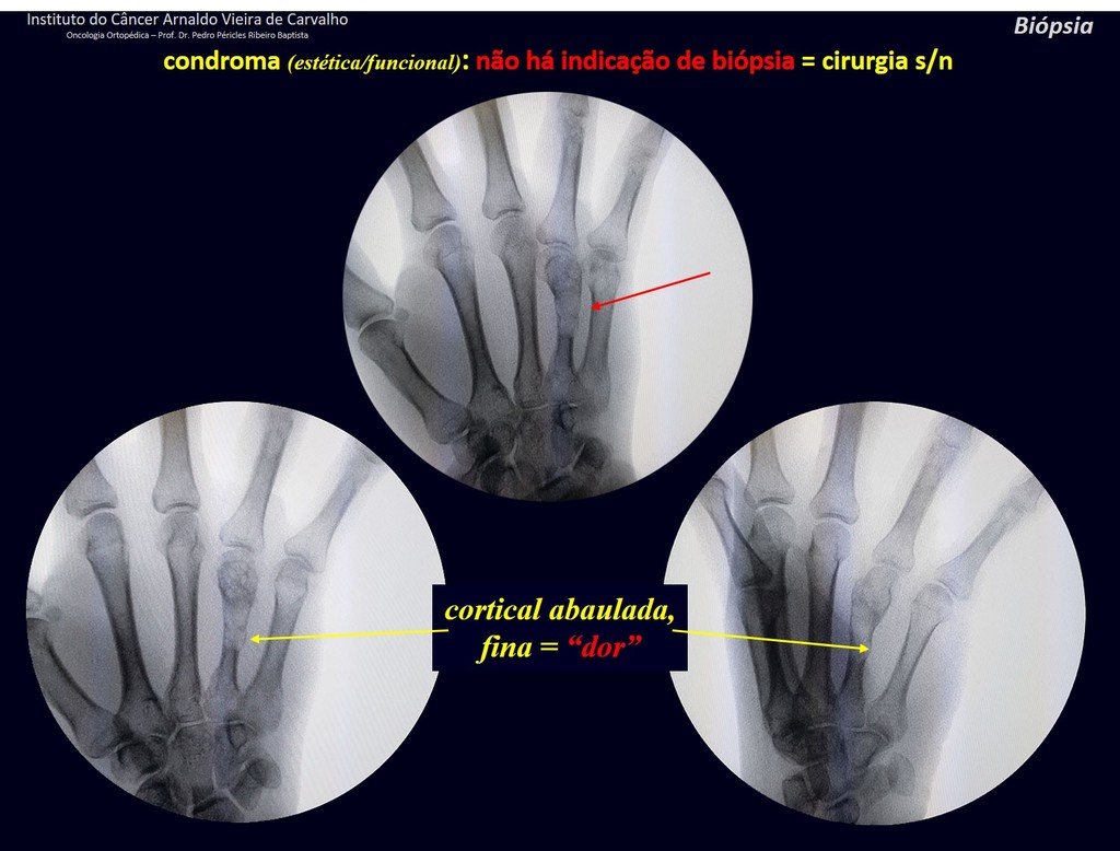 Figura 37: Cortical com insuflações finas causando dor e desconforto. Indicação de curetagem e enxerto autólogo S/N.