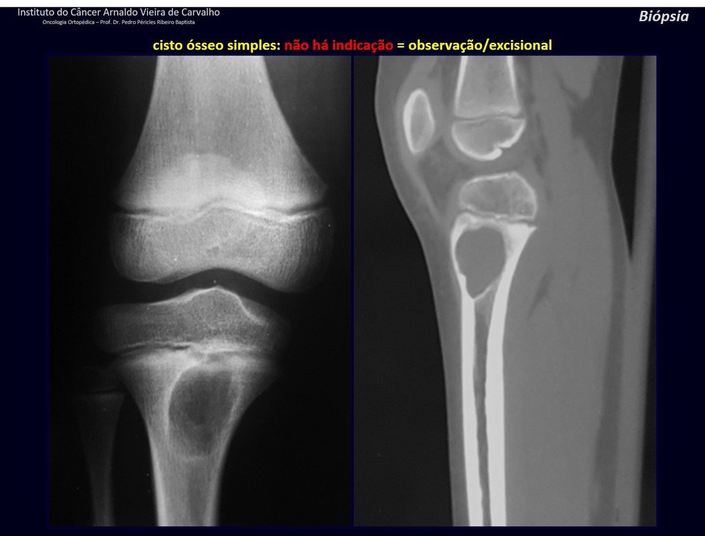 Figura 57: Cisto ósseo simples da tíbia. Dor por tração da tuberosidade tibial pelo ligamento patelar, devido ao afilamento da cortical.