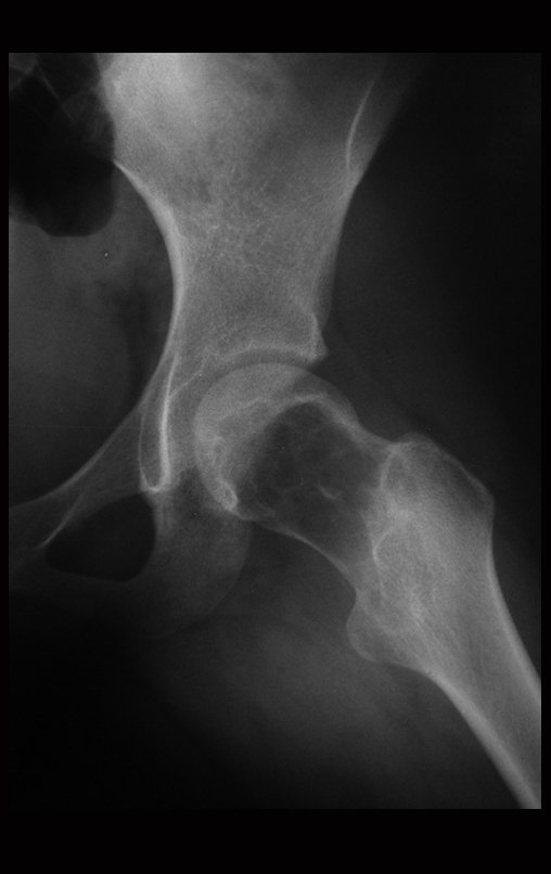 Figura 4: Radiografia em posição de Lowenstein, focalizada no quadril esquerdo.