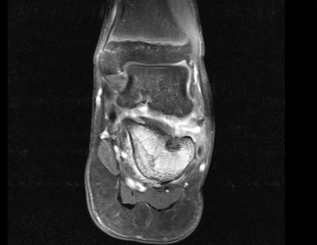 Figura 26: Ressonância coronal T1, fat sat, com lesão no calcâneo e edema articular, objetivando a sintomatologia.