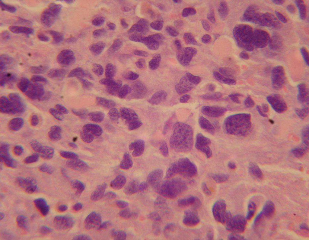 Figura 23: Detalhe ampliado do polimorfismo e hipercromasia, caracterizando um osteossarcoma de alto grau.