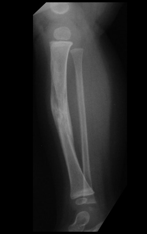 Figura 13: O mesmo se observa na radiografia em perfil.