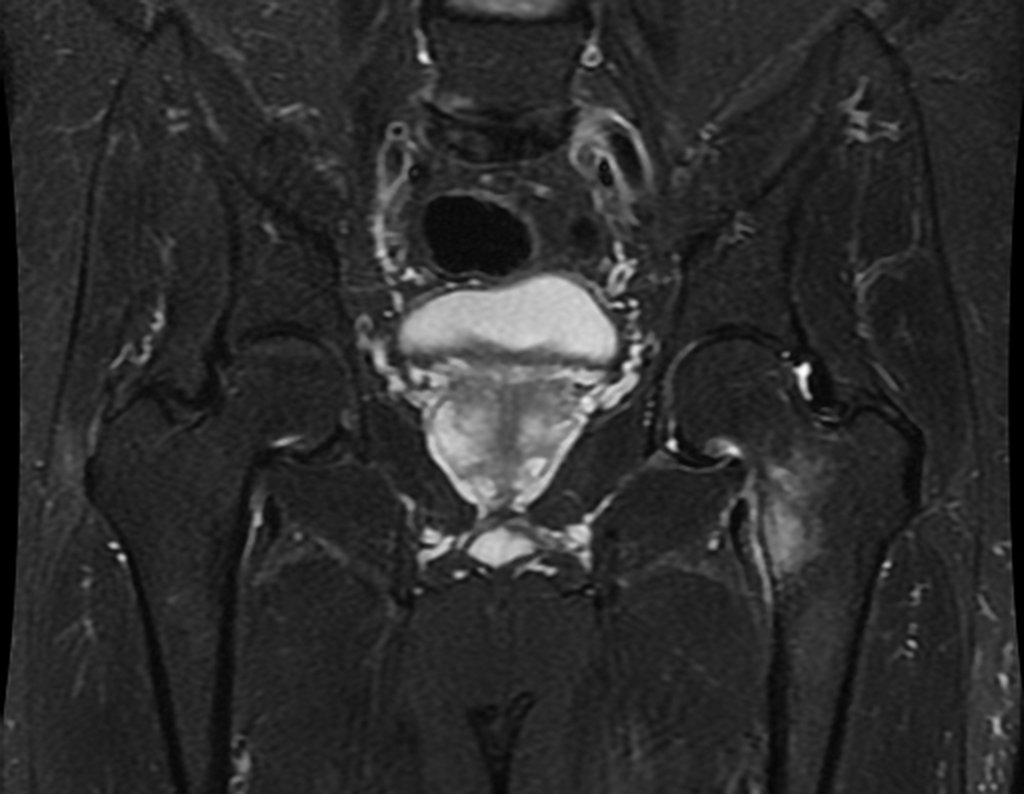 Figura 7: RM coronal, com saturação de gordura, evidenciando a lesão medial do fêmur esquerdo.