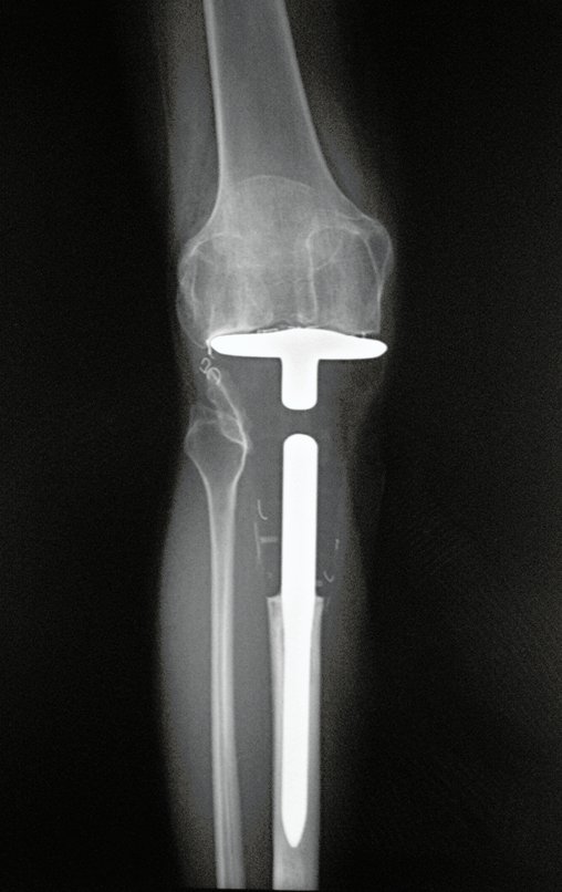 Figura 154: Radiografia, frente. Pós-operatório de nove anos.