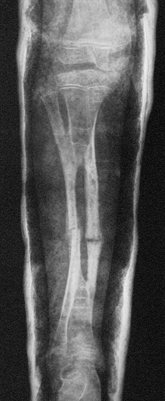 Figura 142: Radiografia de controle após seis semanas, frente, em 21/11/2013