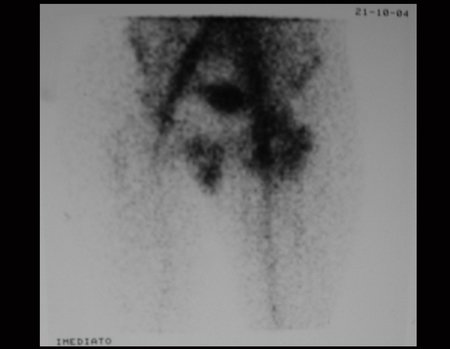 Figura 8: Cintilografia óssea na fase de fluxo, com aumento de captação no quadril esquerdo.