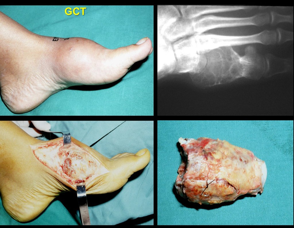 Figura 57: Tumor de células gigantes do primeiro metatarsiano; radiografia com a lesão lítica; incisão e exposição do tumor e peça resseca.